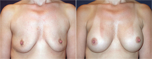 Ohio breast enlargement patient pictures